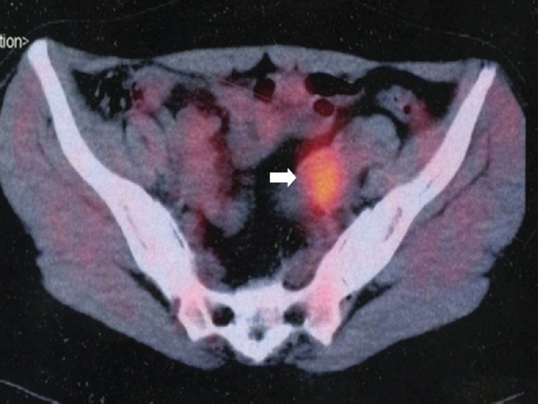 Positron emission tomography and computed tomography scan showing unilateral increased FDG uptake in tubo-ovarian masses (arrow).